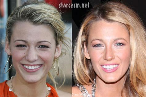 blake lively before and after plastic surgery|blake lively nose job surgeon.